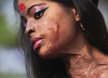 방글라데시염산 테러 피해 여성